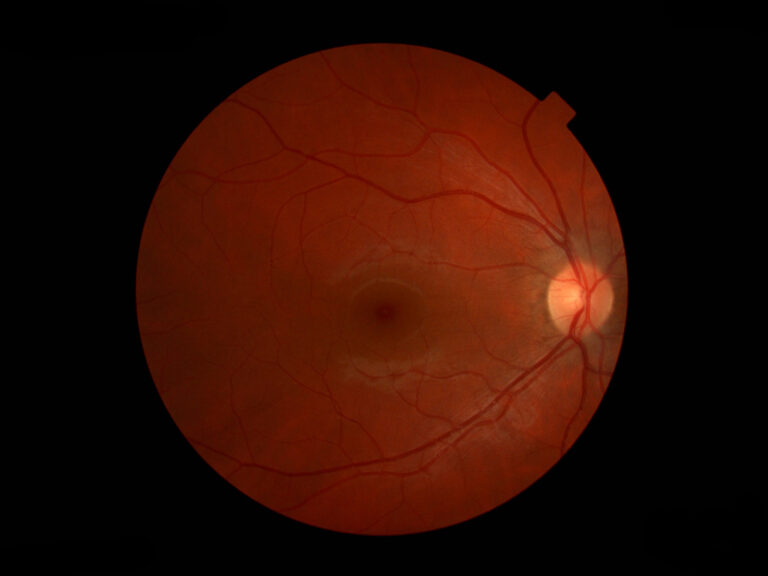 3 kolor snimak normalnog očnog dna