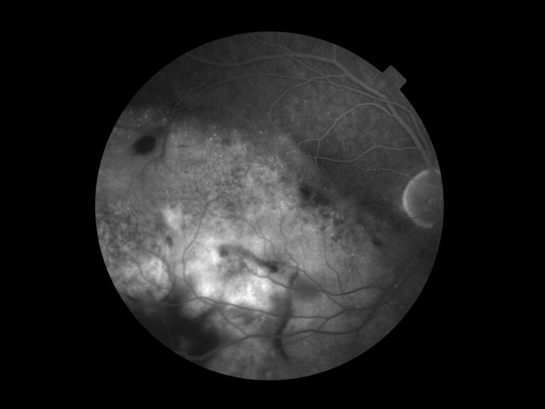 metastaze na očnom dnu nakon operisanog karcinoma pluća